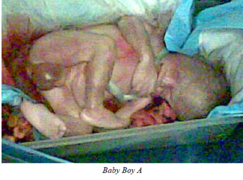 late-term abortion victim abortion after 6 months