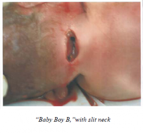 gruesome photo of late term abortion victim