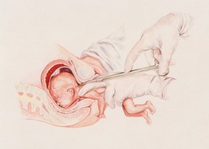partial birth abortion