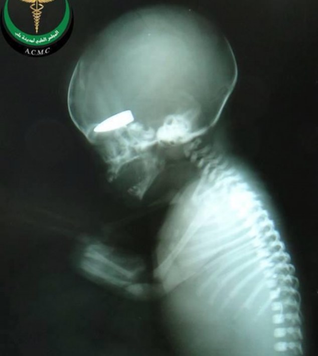 fetus with bullet